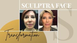 Sculptra: Before & After Results & How it Works (+ Video) - Dominique