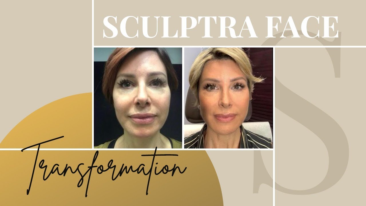 sculptra before and after result